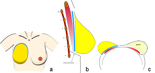 taille et position typiques de l'empreinte (bleu) et du cône (jaune) du sein sur la paroi thoracique en vue frontale (a) sagittale (b) et en décubitus dorsal (c).