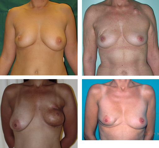 Chirurgie conservatrice du sein: exemples de déformation après segmentectomie et réactions variables à la radiothérapie post-opératoire.