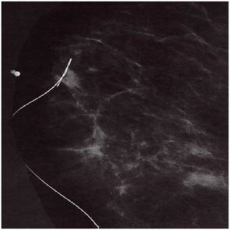 localisation au harpon sous mammographie d’une tumeur non palpable.