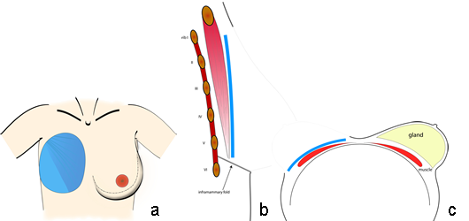 taille et position typiques de l'empreinte du sein sur la paroi thoracique en vue frontale (a), sagittale debout (b) et axiale en décubitus dorsal (c).