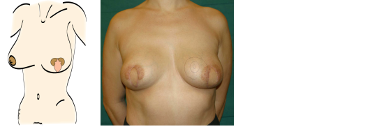 Steps in an areola-sparing mastectomy