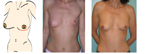 mastectomie sous-cutanée par une incision sous-mammaire.
